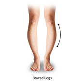 Bow Leg Deformity