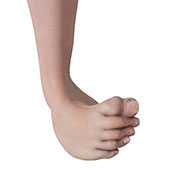 Congenital Deformity and Clubfoot