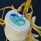 Disc Herniation