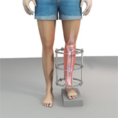 External Fixator Assisted Limb Deformity Correction