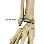 Growth Plate Fracture