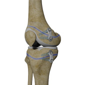 Guided Growth for Leg/Limb Deformity