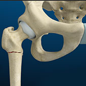 Hip Fracture