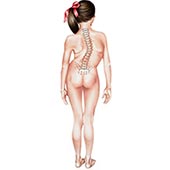 Idiopathic Scoliosis