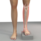 Internal Lengthening for Leg Length Discrepancy
