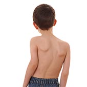 Juvenile Scoliosis