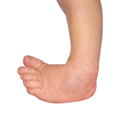 Limb Deformity