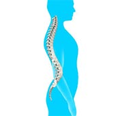 Lordosis