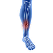 Lower Extremity Fractures