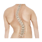 Neuromuscular Scoliosis