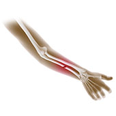 Pediatric Fractures