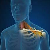 Radiculopathy