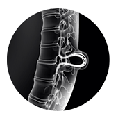 Spina Bifida