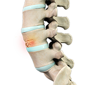 Spinal Fractures