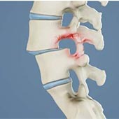Spondylolisthesis
