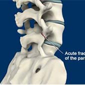 Spondylolysis