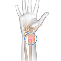 Torus/Buckle fractures