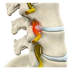 Lumbar Disc Herniation and Radiculopathy