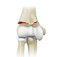 Elbow fractures