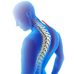 Kyphosis