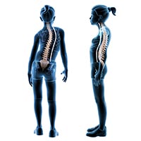 Scoliosis