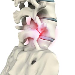 Spondylolysis