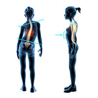 Symptoms of Scoliosis